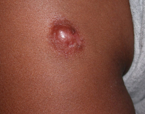 Dermatofibrossarcoma protuberans