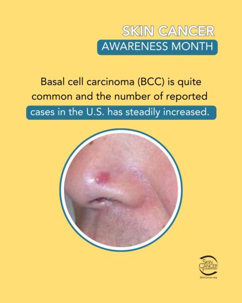 skin-cancer-awareness-month.jpg Skin cancer awareness month poster with an image of basal cell carcinoma on a nose.