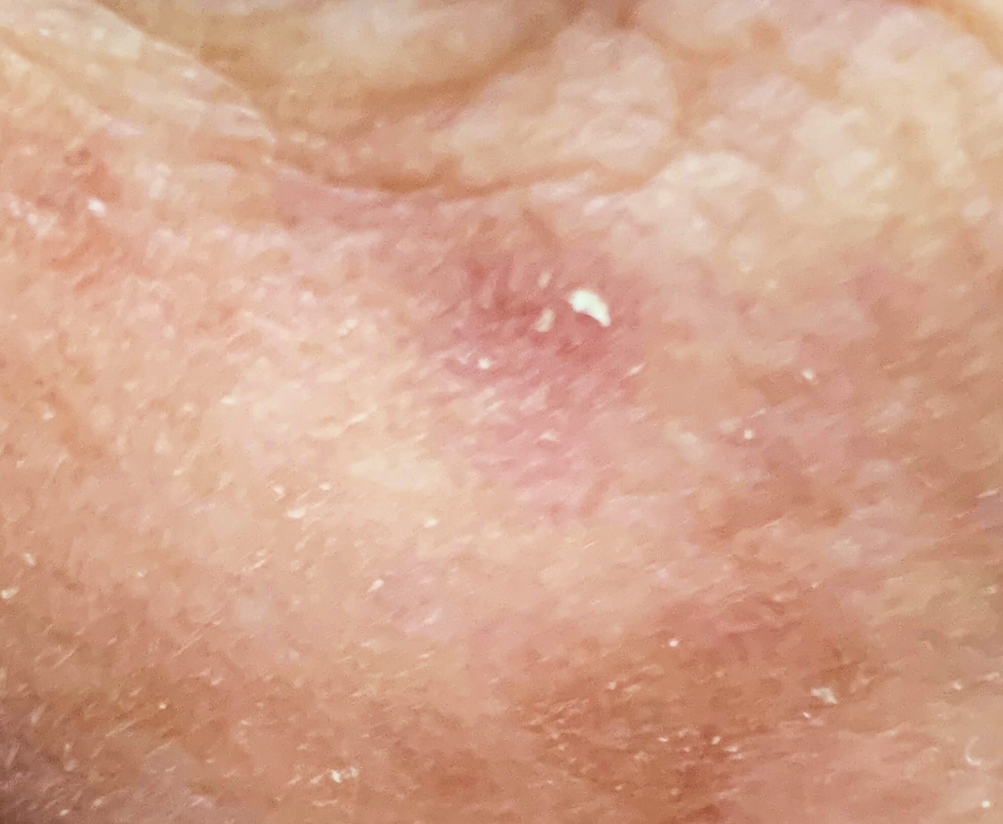 ISIC_1687088 Actinic keratosis on head or neck