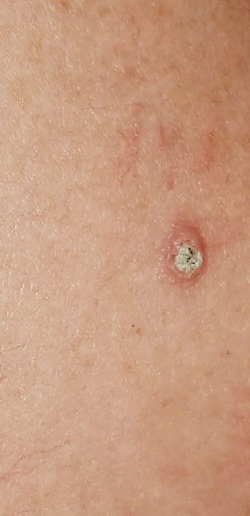 ISIC_9129115 Atinic keratosis on posterior torso
