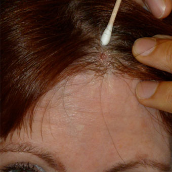 2. Juli Hautkrebsläsion entfernt