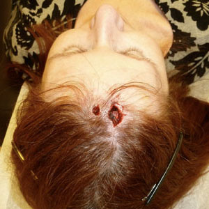 4. Juli Operation zur Entfernung von Hautkrebs