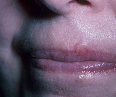 Carcinoma anexial microcístico