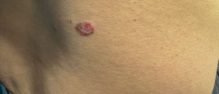 Carcinoma de células escamosas avermelhado e elevado