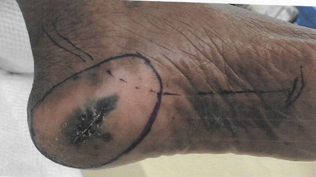 Stage II acral lentiginous melanoma on left foot.