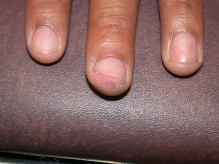 Bowen's disease (SCC in situ) on the finger of a Black man