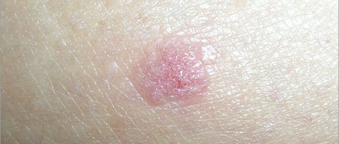 Carcinoma de células escamosas em pele clara