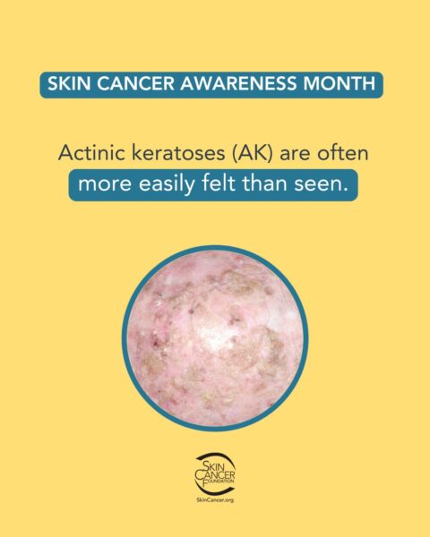 skin-cancer-awareness-month-actinic-keratoses.jpg Skin Cancer Awareness Month poster with text "Actinic keratoses (AK) are often more easily felt than seen," image of skin condition inside a blue circle, and Skin Cancer Foundation logo.