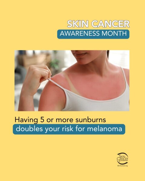skin-cancer-awareness-month A Skin Cancer Awareness Month poster with a photo of a woman with sunburn and a warning about increased melanoma risk.