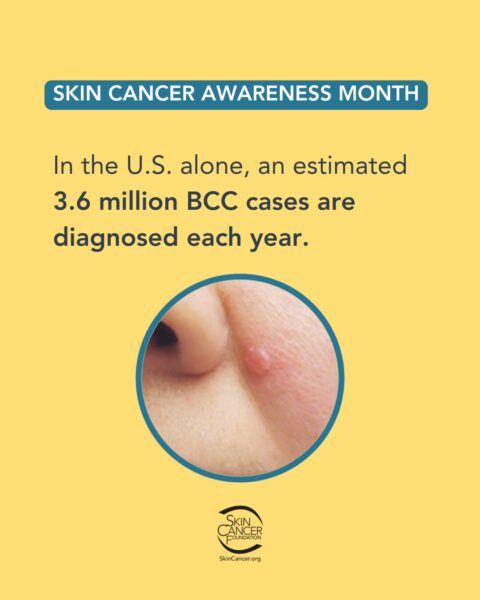 skin-cancer-awareness-month-image Skin Cancer Awareness Month image with information about BCC diagnosis rates in the U.S. and a photo of a skin lesion.