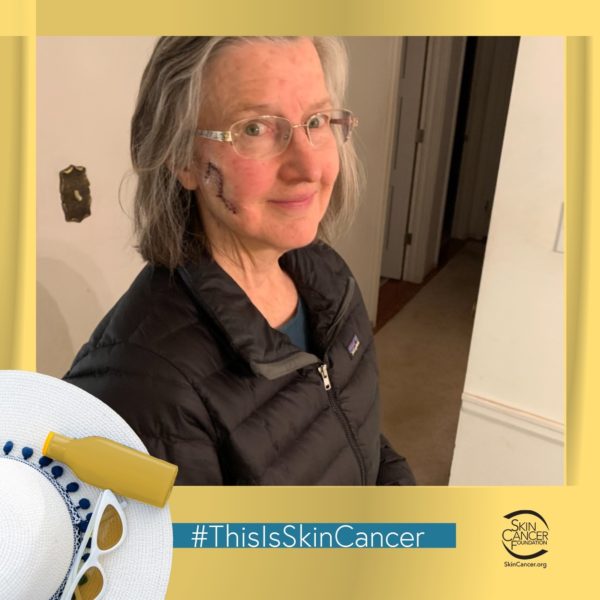 Foto de fotomatón #ThisIsSkinCancer con cicatriz