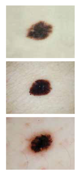 d es para melanoma oscuro - pila de imágenes