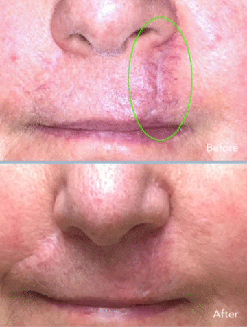 combinación de dermoabrasión y láser de CO2 para tratar cicatrices