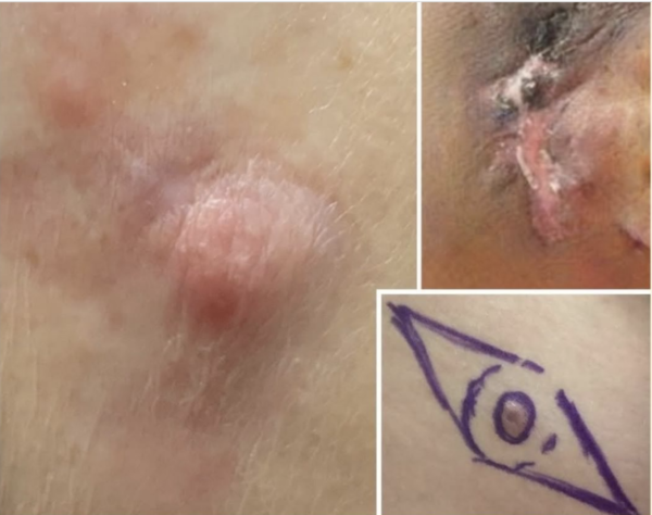 Dermatofibrossarcoma Protuberans