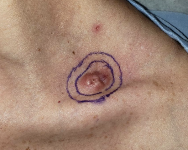 dermatofibrossarcoma protuberante dfsp